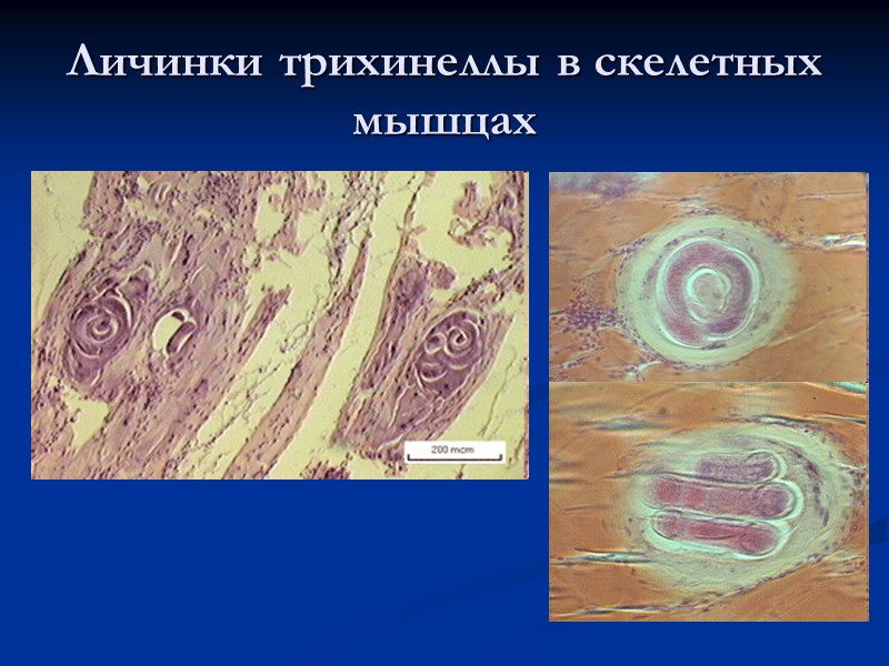 Личинки трихинеллы в скелетных мышцах